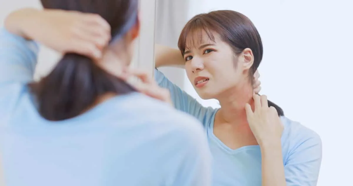 アトピー持ちの20〜40代、帯状疱疹リスクが最大51％増の衝撃データ